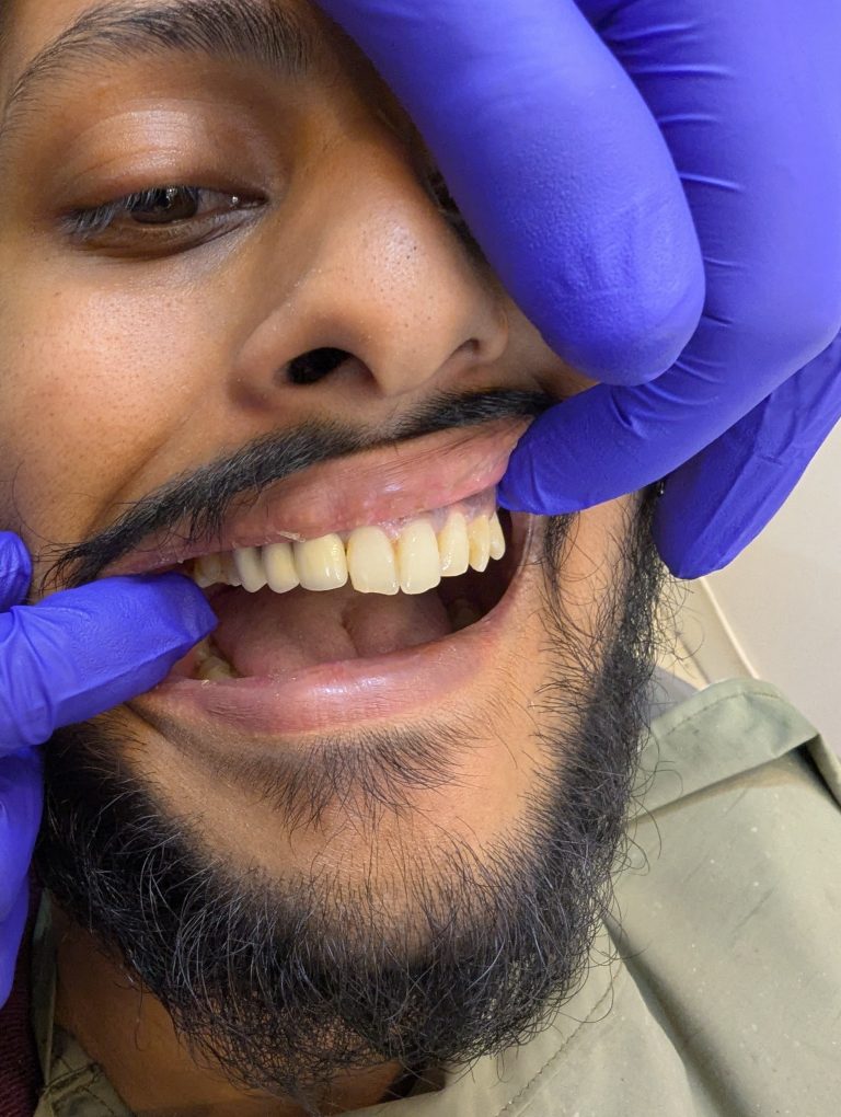 After crown replacement