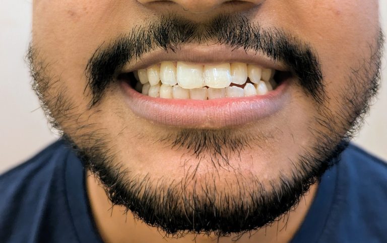 After laser cosmetic filling