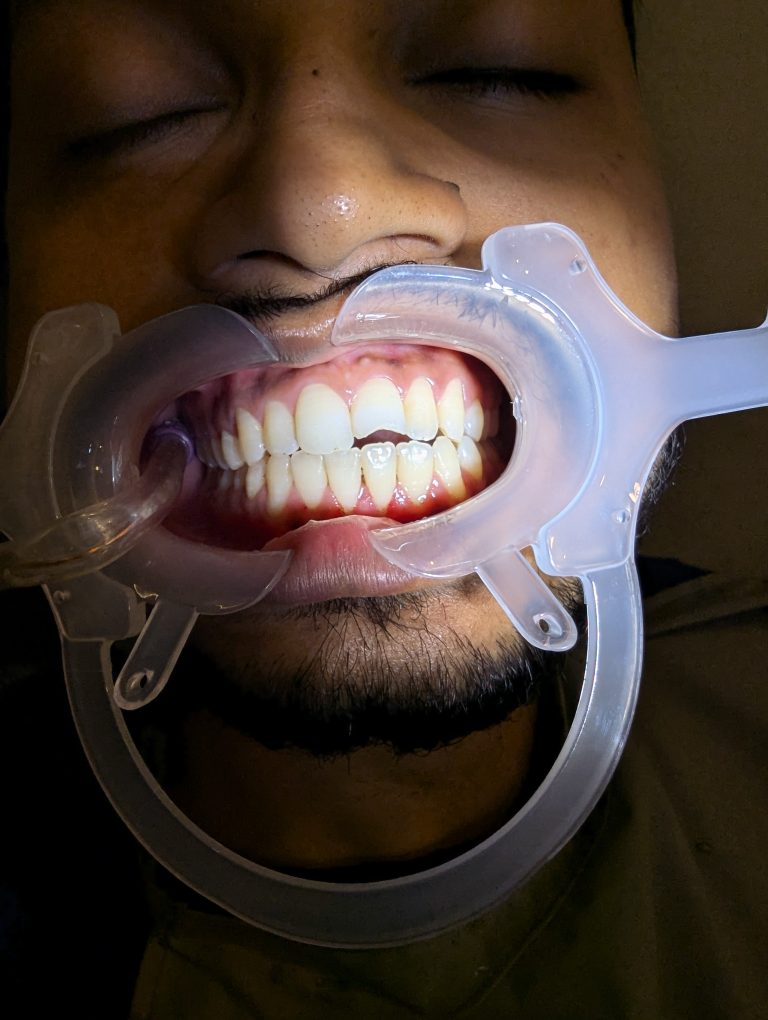 Before laser cosmetic filling