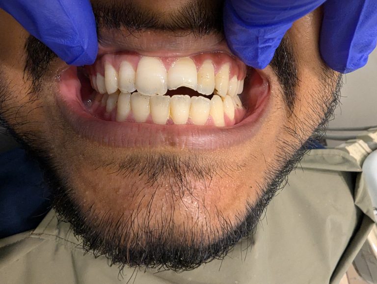 Before laser cosmetic filling