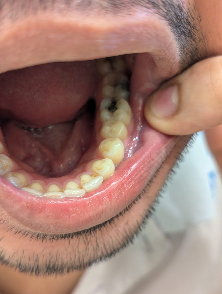 Dental Carries into molar teeth