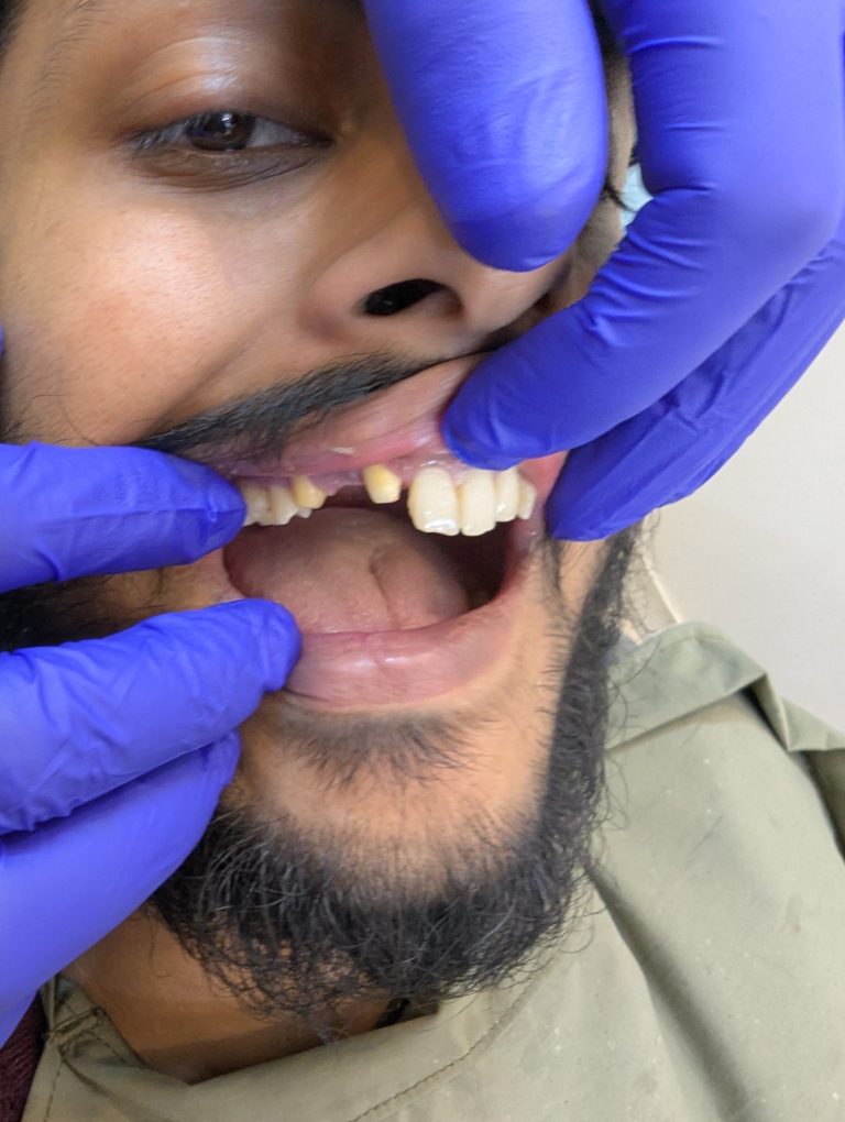 Missing tooth (before replacement)