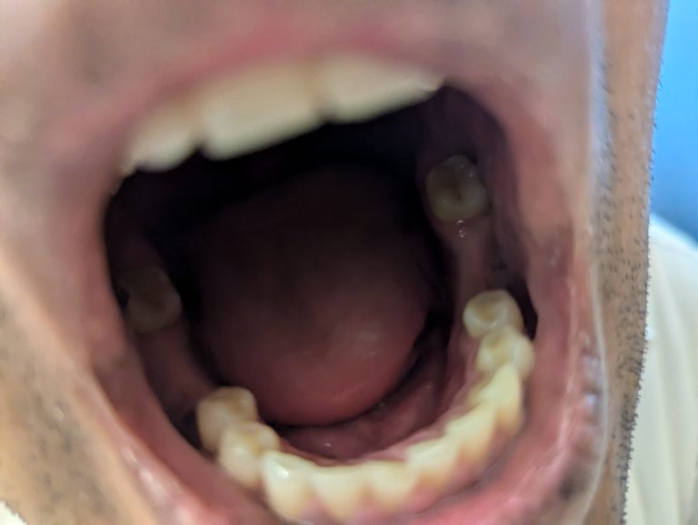 Multiple missing teeth