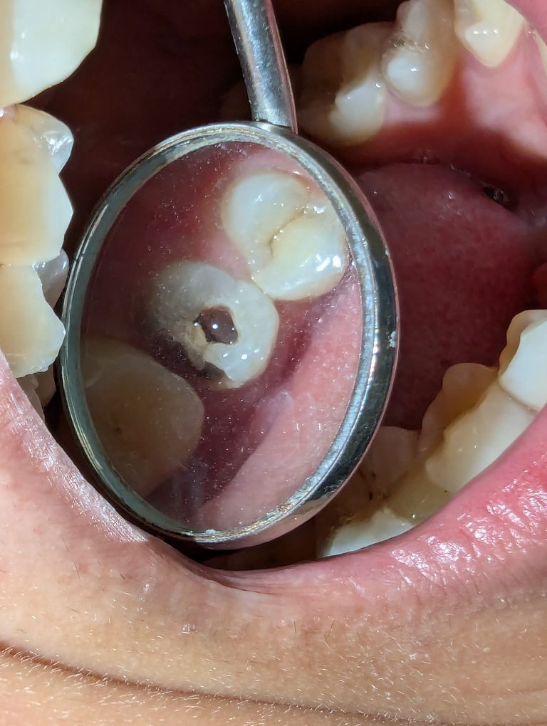 Pus and abscess formation into teeth