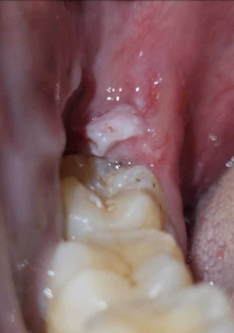 A case of cheek bite