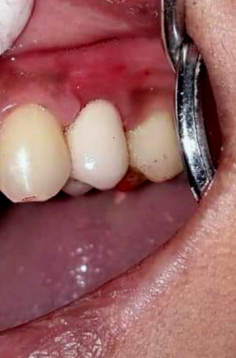 after dental bridge