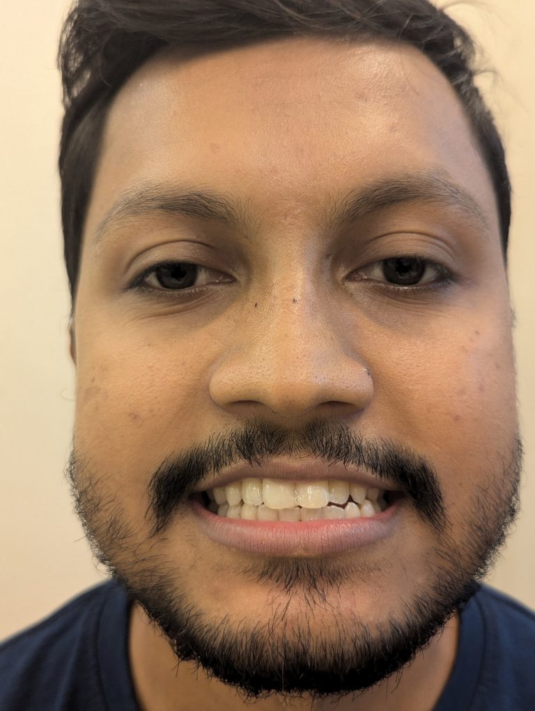 after laser cosmetic filling