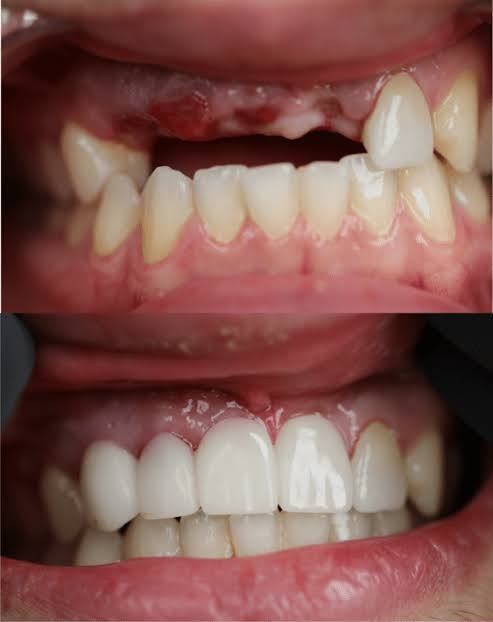 before and after image of dental bridge of zirconia crown