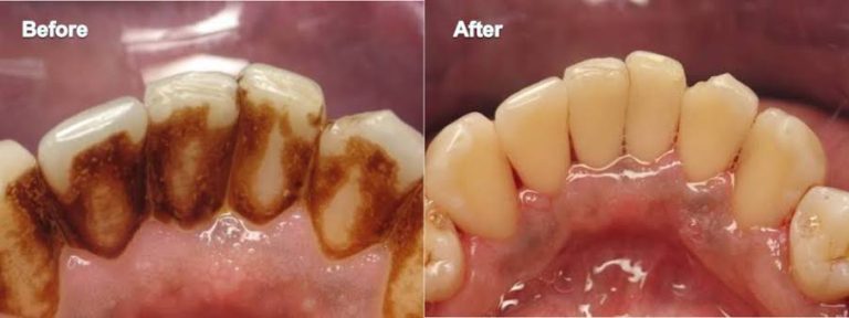 before and after image of dental scaling and polishing