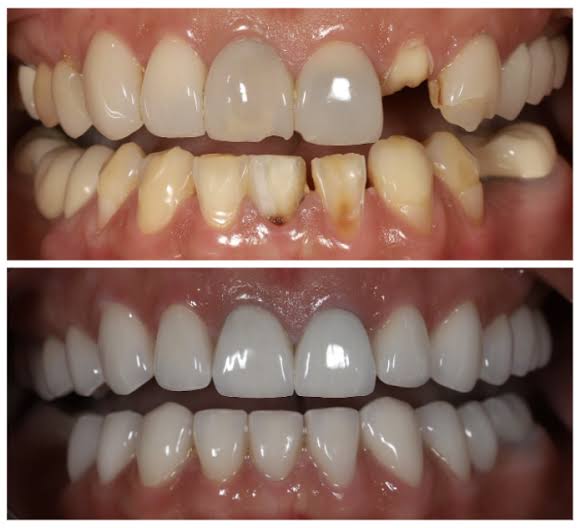 before and after image of scaling polishing and dental filling