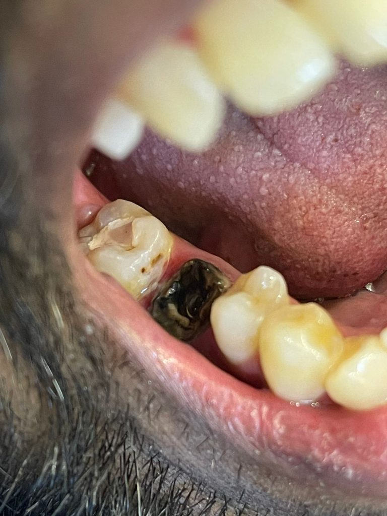 Broken down crown in molar tooth image