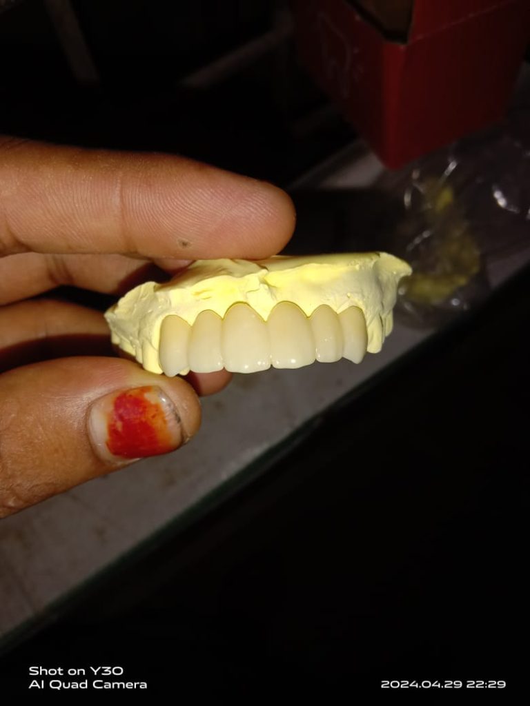 lab preparation of 6 unit zirconia crown