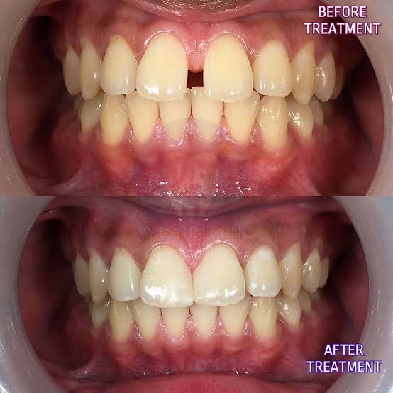 laser composite filling before and after image