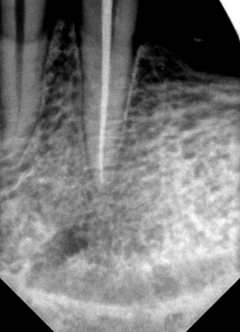 root canal seal