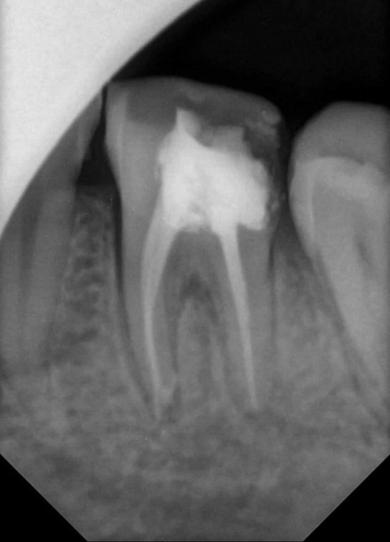 Root canal seal x ray